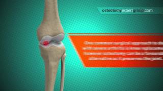 Why Do An Osteotomy  Osteotomy [upl. by Nnyledam]