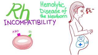 Rh Incompatibility Hemolytic Disease of the Newborn Erythroblastosis fetalis FLImmuno65 [upl. by Anitsihc768]