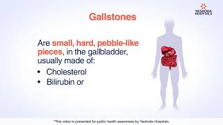 Gallstones  Cholelithiasis Symptoms Causes Diagnosis and Treatment [upl. by Ellie]