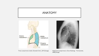 Mediastinal Masses [upl. by Suoivatnod]