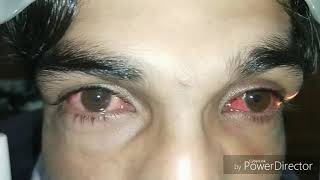 Adenoviral Conjunctivitis [upl. by Douglass]