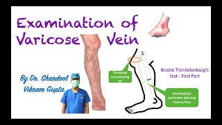 Examination of Varicose Vein for MBBS MS Surgery medical students [upl. by Timmons]