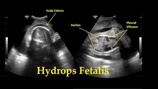 Hydrops Fetalis  Ultrasound  Anomaly  Case 26 [upl. by Irrej]