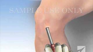 Knee Arthroscopy [upl. by Nnylarej]