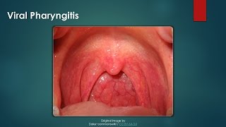 Viral Pharyngitis [upl. by Annonyw]