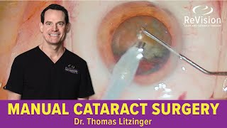 Manual Cataract Surgery WATCH SURGERY [upl. by Rettig291]