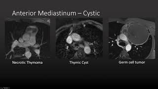 Approach to Mediastinal Masses [upl. by Ericksen]